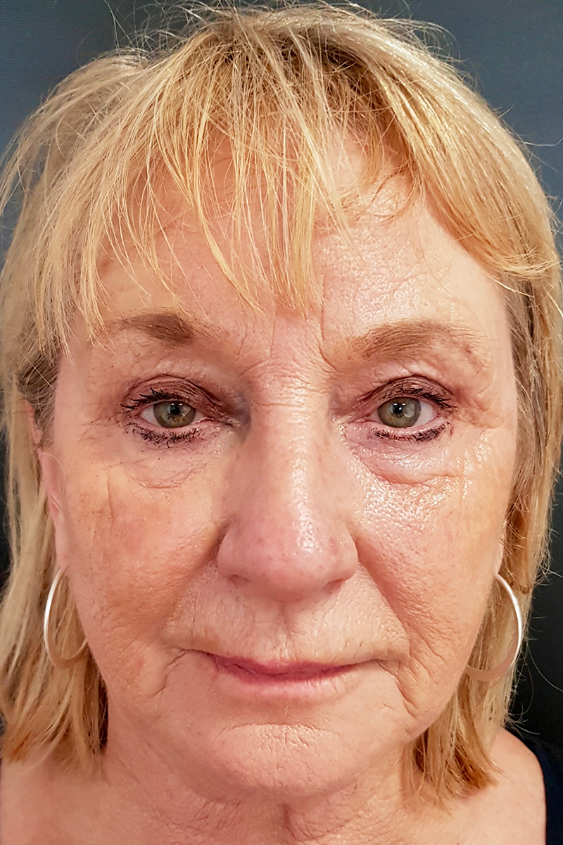 View 1 — before (pre-operative)